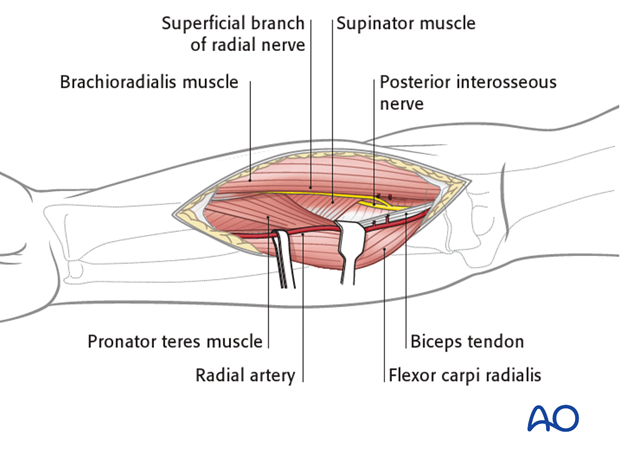 Anterior approach henry 