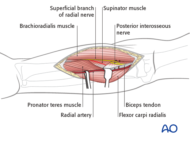 Anterior approach henry 