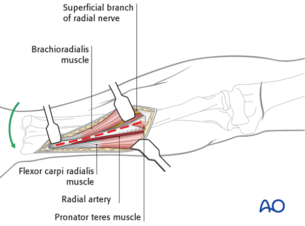 Anterior approach henry 