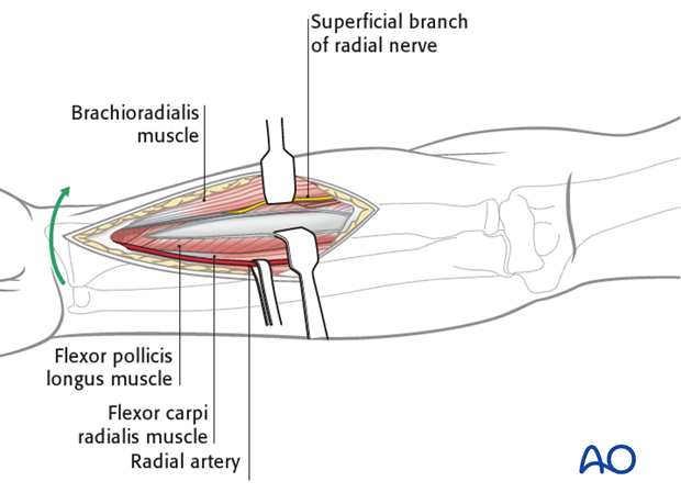 Anterior approach henry 