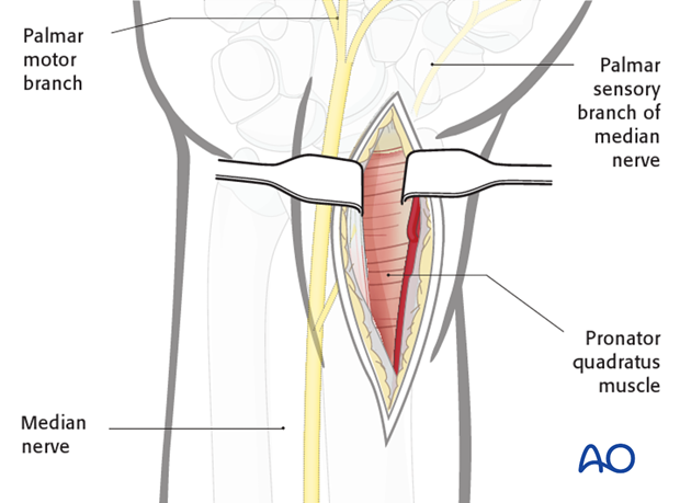 Anterior approach henry 