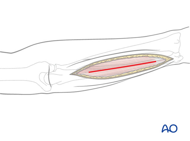 Approach to the ulna