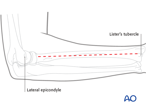 Posterolateral approach (Thompson)