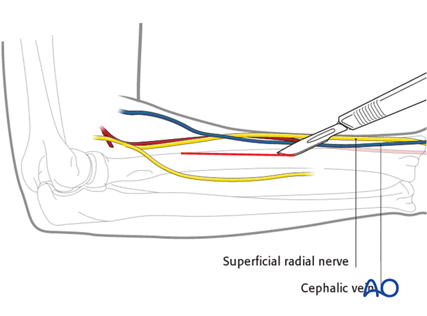 Posterolateral approach (Thompson)