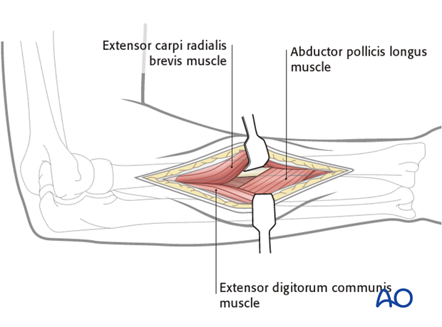 Posterolateral approach (Thompson)