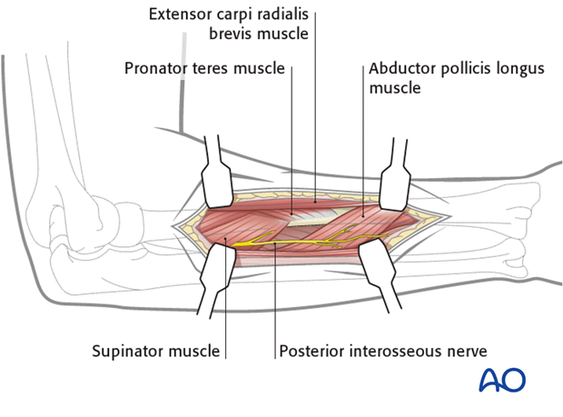 Posterolateral approach (Thompson)