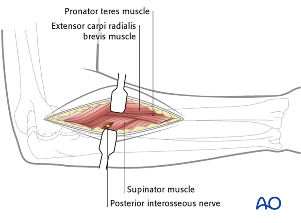 Posterolateral approach (Thompson)