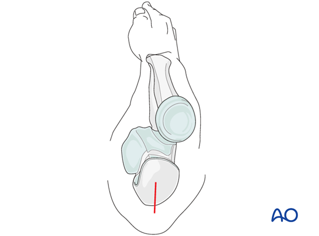 Approach to the ulna for intramedullary nailing