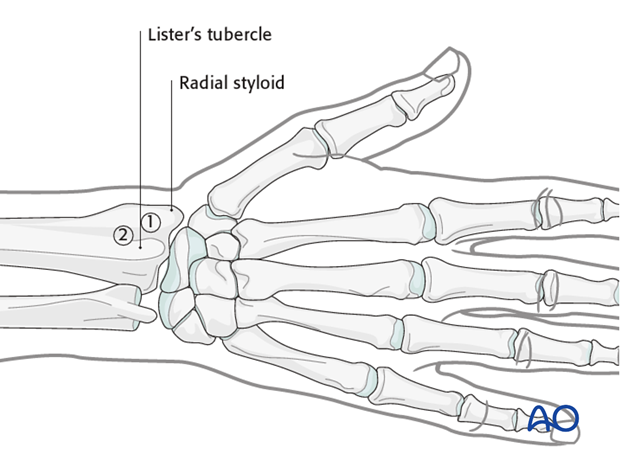 Approaches to the radius for intramedullary nailing