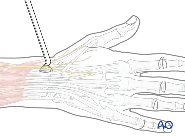 Approaches to the radius for intramedullary nailing