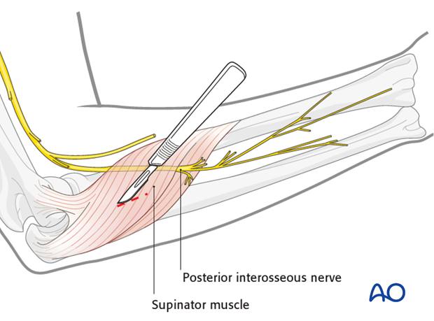 Safe zones for pin placement in the forearm