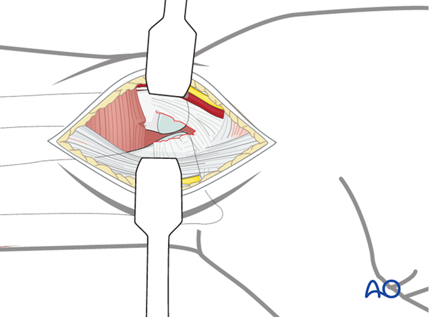 Approaches to the DRUJ (posterior/anterior)