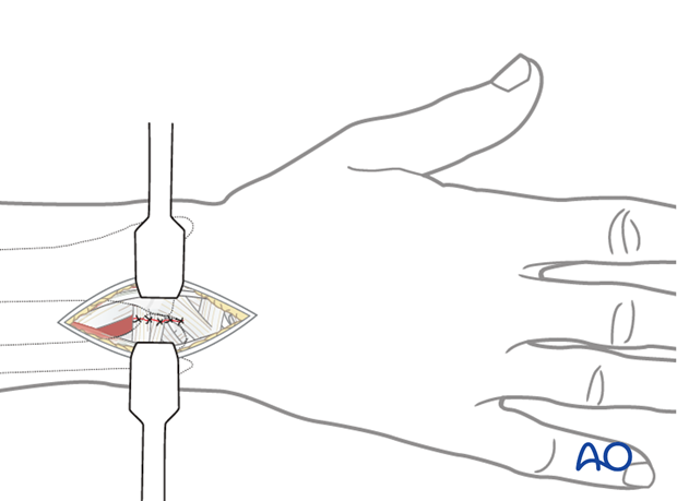 Approaches to the DRUJ (posterior/anterior)