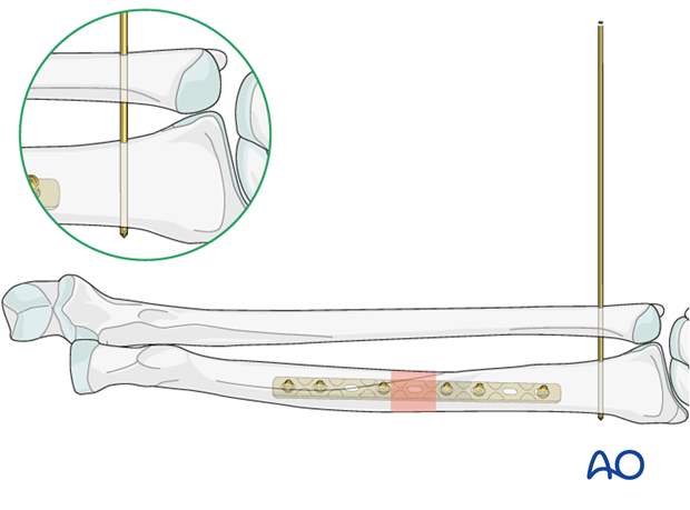 Approaches to the DRUJ (posterior/anterior)