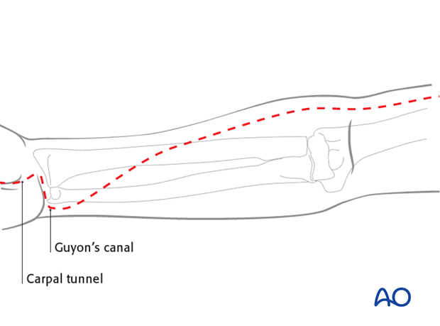 compartment syndrome