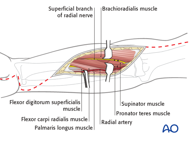 compartment syndrome