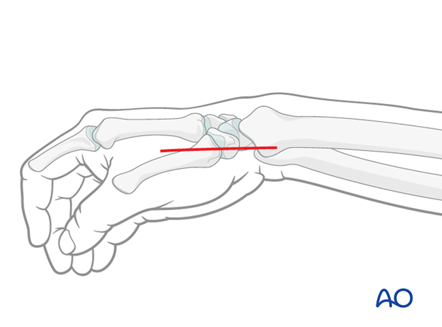 direct approach to the radial styloid