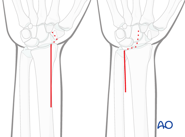 ulnar palmar approach to the distal radius