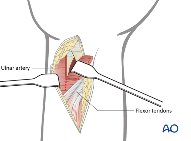 ulnar palmar approach to the distal radius