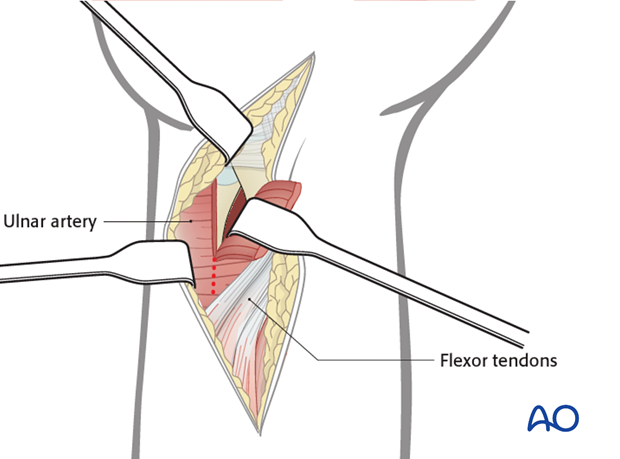 ulnar palmar approach to the distal radius