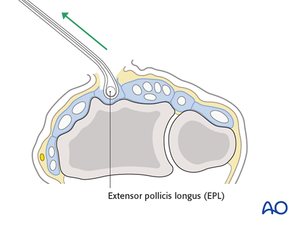 dorsal approach