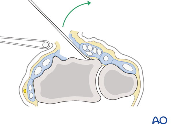 dorsal approach