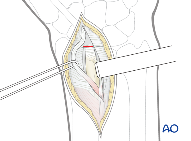 dorsal approach