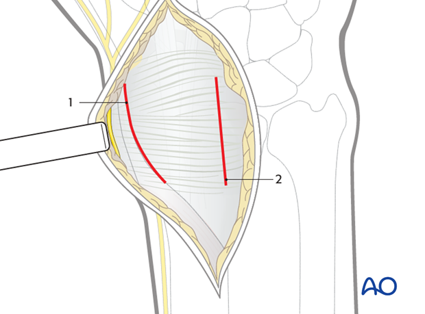 dorsal approach