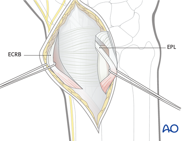 dorsal approach