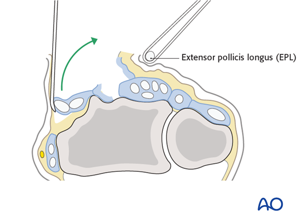 dorsal approach