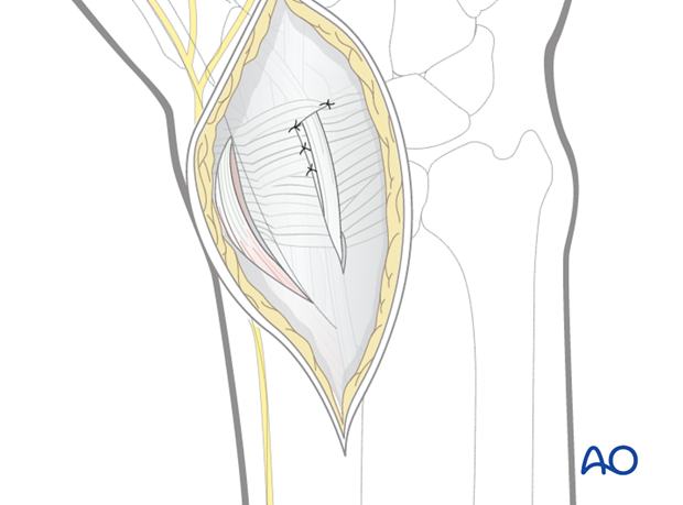 dorsal approach