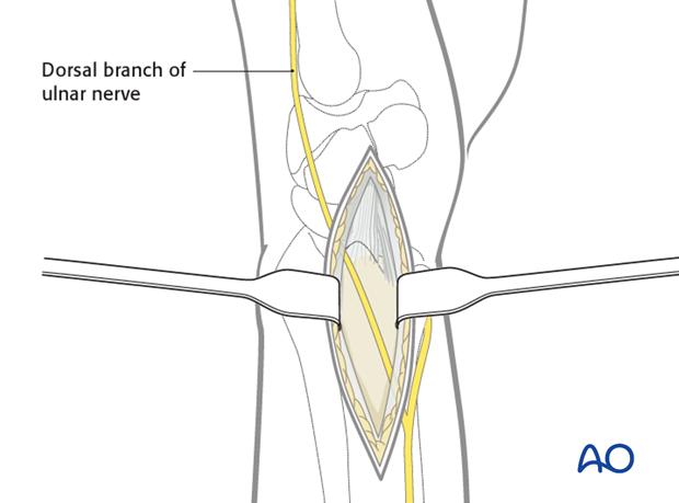 ulnar approach to the distal ulna