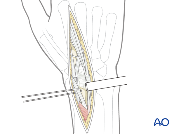 dorsal approach for joint spanning plate