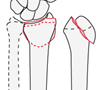 distal forearm