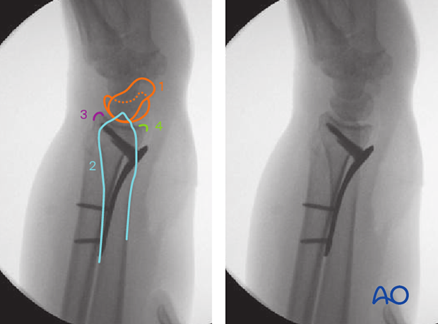 Anatomical lines and landmarks of the distal forearm and wrist in the lateral view