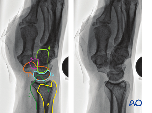 Anatomical lines and landmarks of the distal forearm and wrist in the lateral view