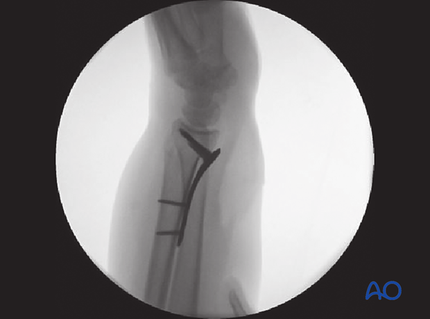 Lateral view of the distal forearm and wrist with plate fixation of the distal radius