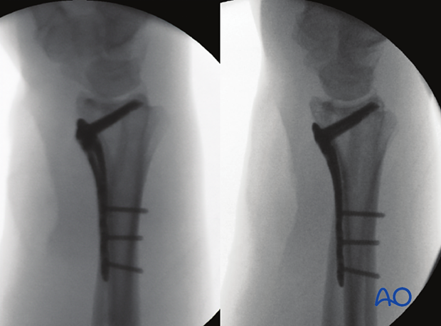 Lateral tangential views of the distal forearm and wrist with plate fixation of the distal radius