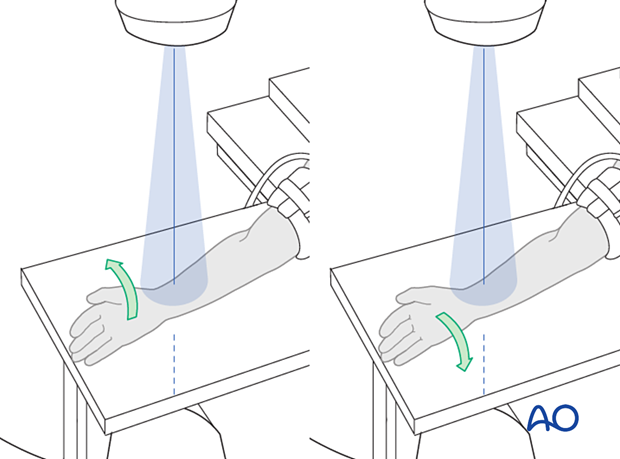 Positioning of the distal forearm and wrist for optimal oblique views