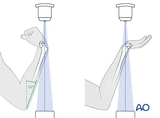 Positioning of forearm and wrist for optimal dorsal tangential and skyline views