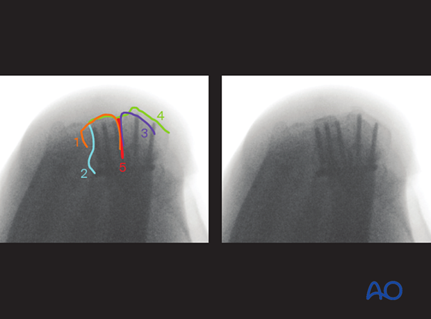 Anatomical lines and landmarks of the distal forearm and wrist in the dorsal tangential view