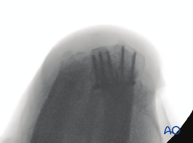 Correct intraoperative dorsal tangential view of the distal forearm