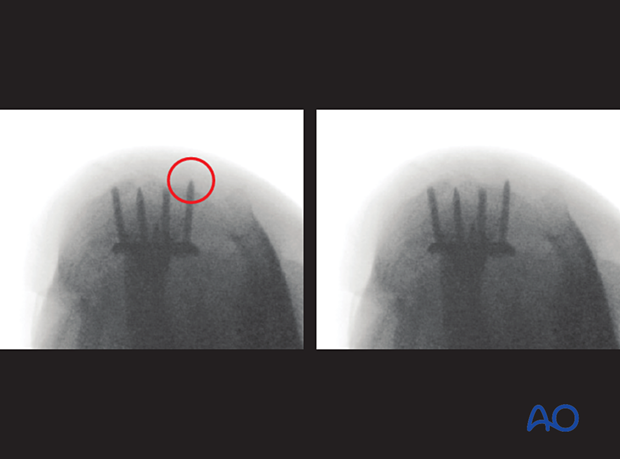 Intraoperative dorsal tangential view showing screw penetration of 3rd compartment