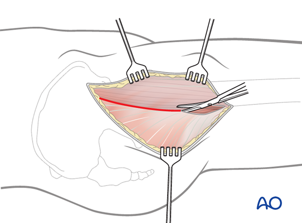 Exposure of the fascia lata along the posterior border of the tensor fasciae latae in the anterolateral approach (Watson-Jones) to the proximal femur