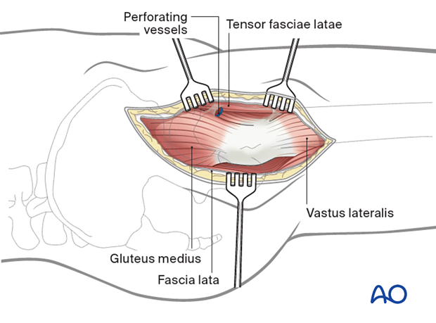 Retraction of the tensor fasciae latae anteriorly and the gluteus medius posteriorly in the anterolateral approach (Watson-Jones) to the proximal femur