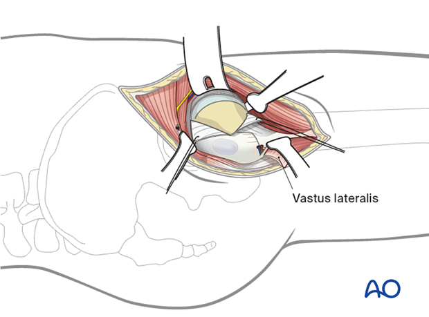 Opening the hip joint capsule in the anterolateral approach (Watson-Jones) to the proximal femur