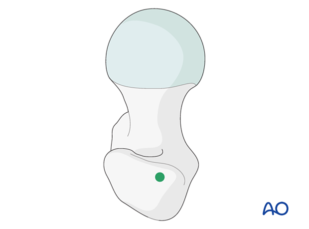 Entry site through the greater trochanter for proximal femoral nailing