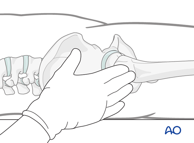 Manual identification of the tip of the greater trochanter and the axis of the femur.