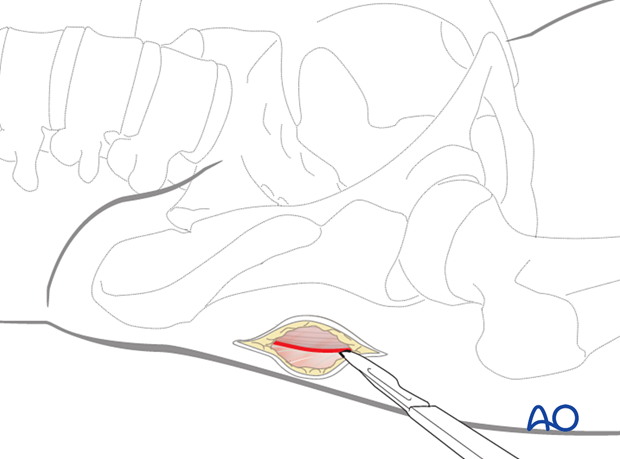 Incision in the fascia of the gluteus muscle, centered on the skin mark, for proximal femoral nailing