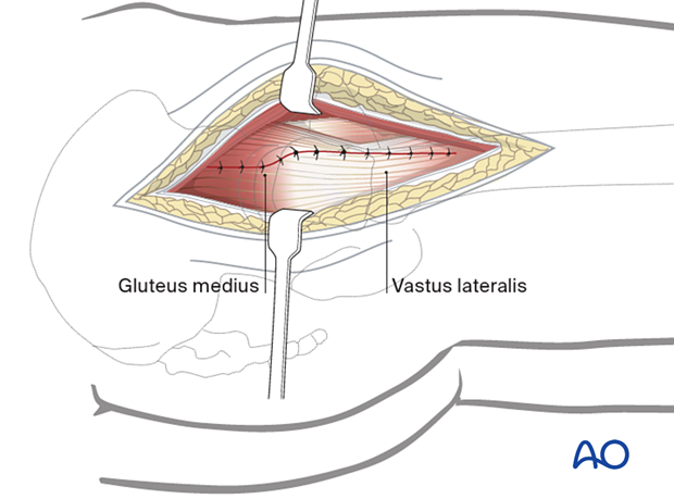 Wound closure of the direct lateral approach to the proximal femur